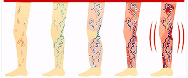 Was man bei Krampfadern nicht tun sollte