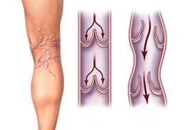 Ausfluss von Blut in Krampfadern in verschiedenen Stadien der Krankheitsentwicklung